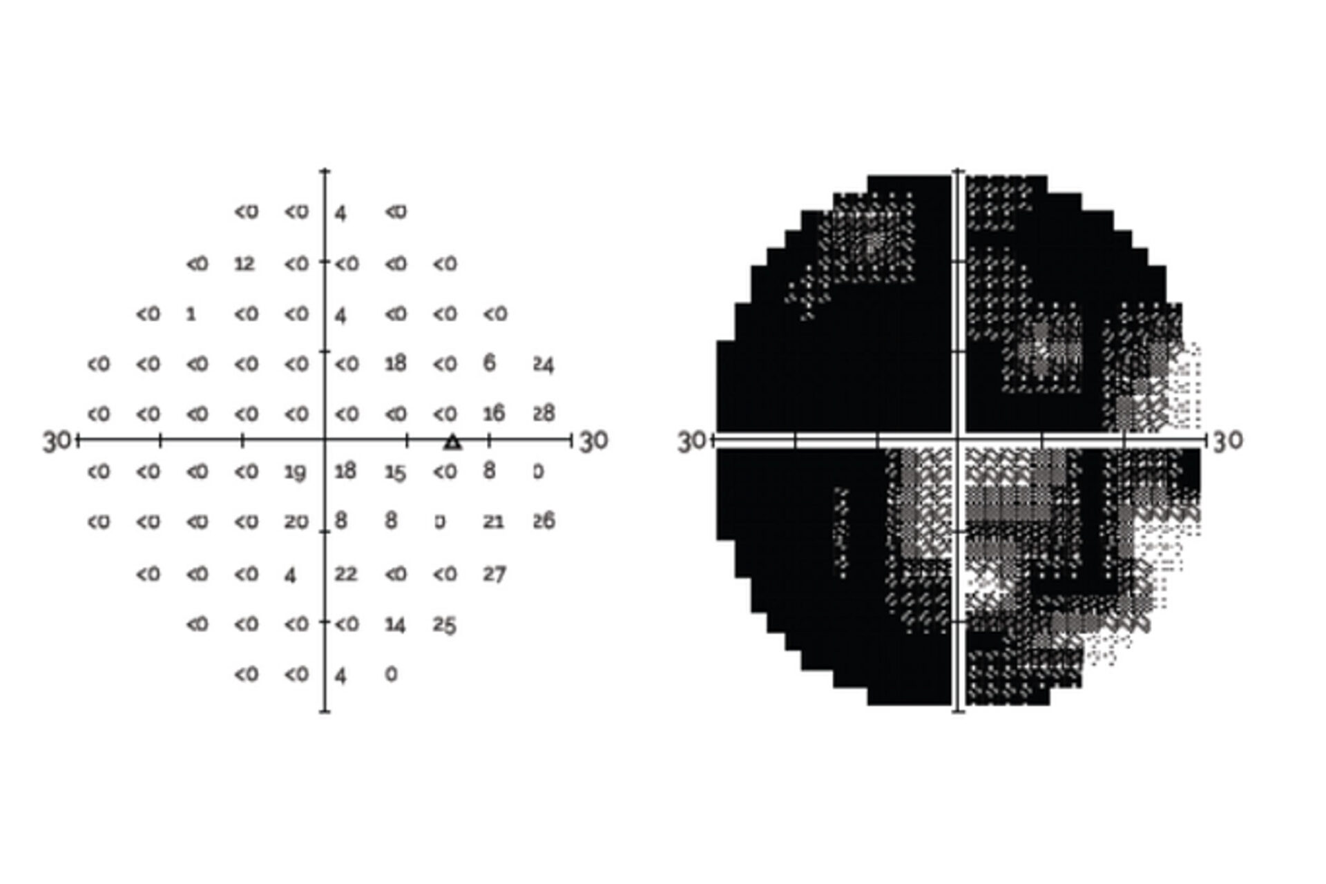 Inter-test Comparability of a Novel VR Perimetry Device with the Humphrey Visual Field Analyzer