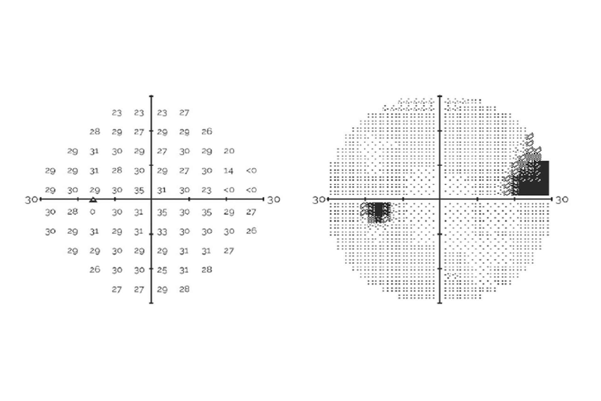 Evaluation of a Virtual Reality-Based Device (RVF100) for Visual Field Testing: A Comparison with the Humphrey Visual Field Analyzer